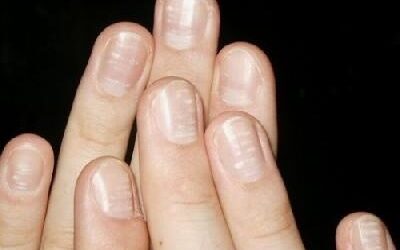 Les taches blanches sur les ongles ne sont pas dues à un manque de calcium