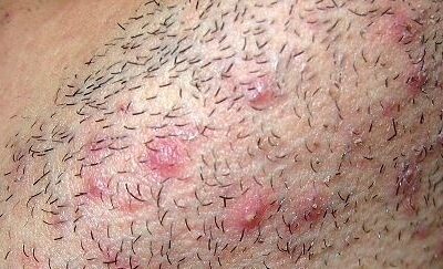 POIL INCARNÉ : COMMENT L&rsquo;ÉVITER ?
