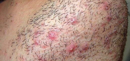 POIL INCARNÉ : COMMENT L'ÉVITER ? - Dr Denjean, dermatologue ...