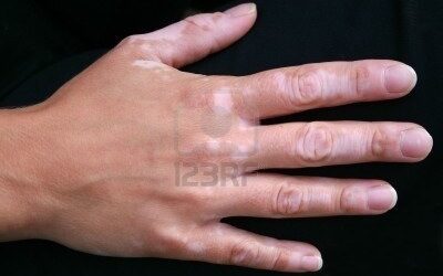 Un nouvel espoir dans le traitement du vitiligo