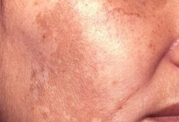 Le mélasma ou chloasma