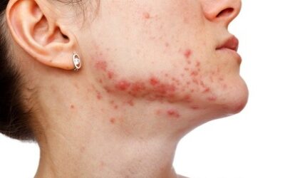 L&rsquo;acné est une maladie dermatologique fréquente