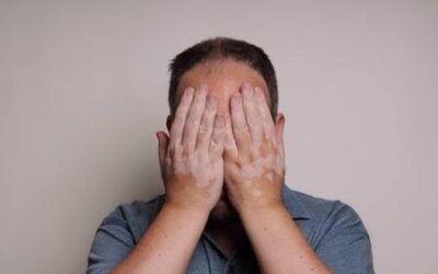 Les fibroblastes au secours du vitiligo ?