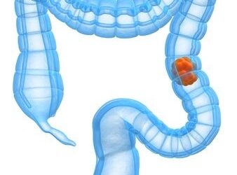 Cancer colorectal : nouveau test de dépistage plus fiable