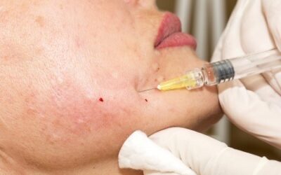 Les skinboosters et le vieillissement cutané