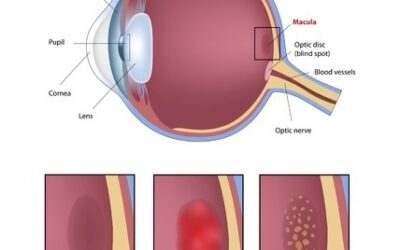 Un médicament contre la maladie de Parkinson pourrait prévenir la DMLA