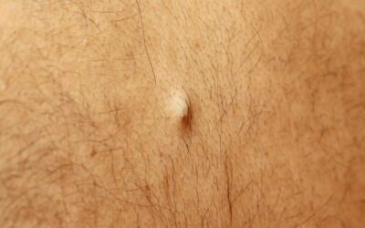 Kyste sébacé, comment le traiter ?