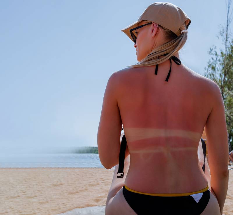 Après une exposition au soleil, une femme en casquette avec un coup de soleil. La peau rouge douloureuse sur le dos qui semble chaude au toucher après les visites Crème solaire ou de protection UV indispensable avant cancer - Cabinet du Docteur Dominique DENJEAN à PARIS