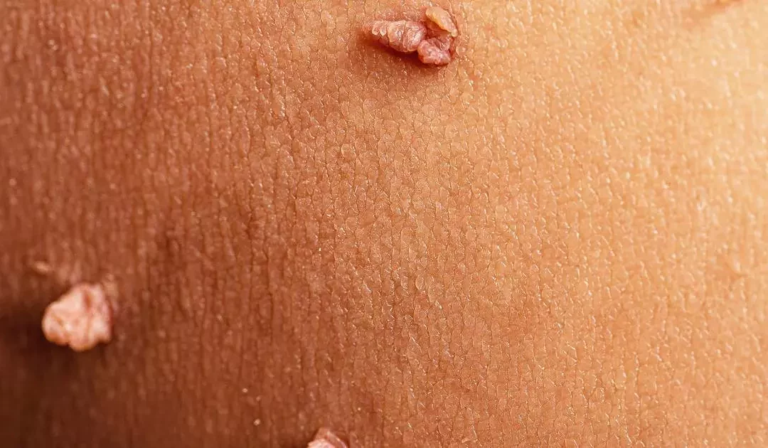 Acrochordon : faut-il les enlever et comment les traiter ?