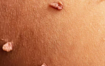 Acrochordon : faut-il les enlever et comment les traiter ?