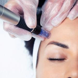 Renouvellement cutané et amélioration progressive de la peau avec le microneedling