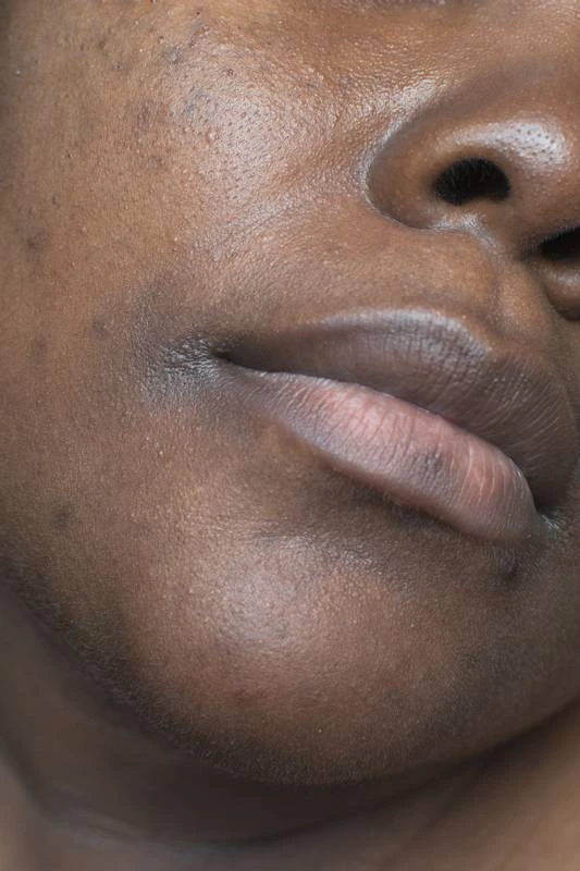 hyperpigmentation du visage sur peau noire avec taches pigmentaires