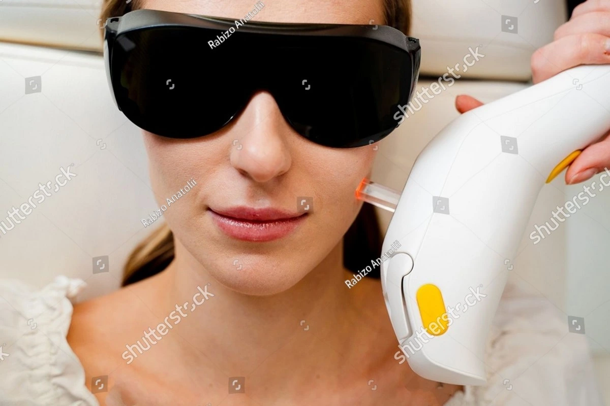 Traitement laser de la rosacée en dermatologie esthétique